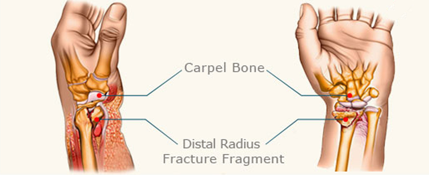 WRIST FRACTURE Care2Cure Physiotherapy Rehab Center