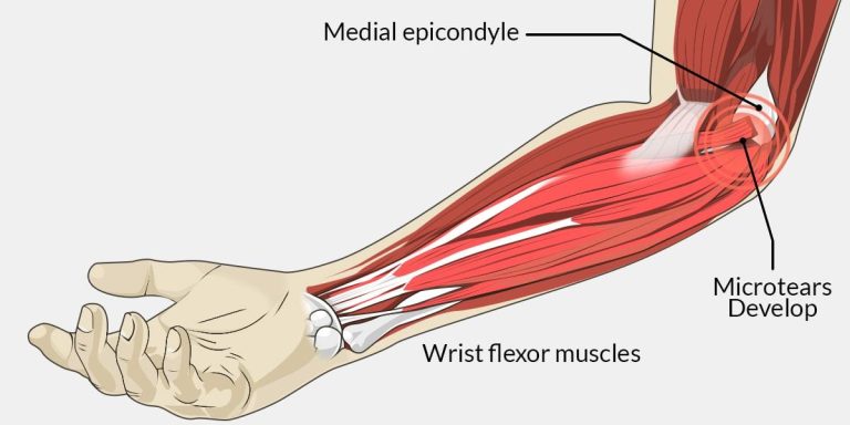 suffering-from-golfer-s-elbow-are-you-then-physiotherapy-is-your-new